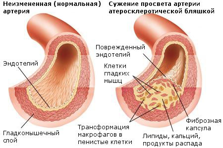 arteriosclerotic